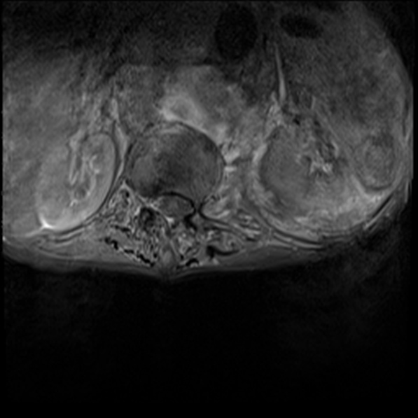 File:Aortic aneurysm with spinal destruction (Radiopaedia 42301-45409 Axial T1 fat sat 4).jpg