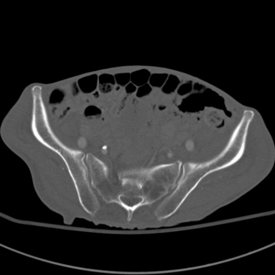 Aortic aneurysm with spinal destruction (Radiopaedia 42301-45410 Axial bone window 84).jpg