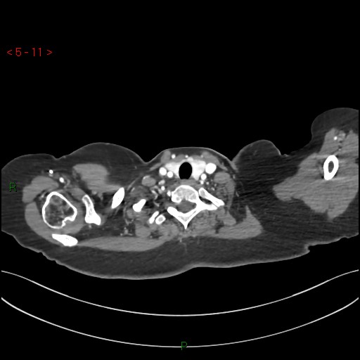 File:Aortic arch origin of left vertebral artery (Radiopaedia 51520-57286 A 10).jpg