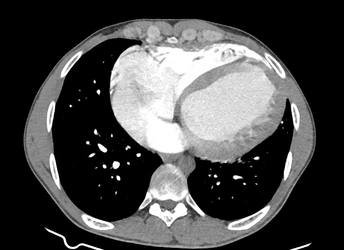 File:Aortic coarctation with aneurysm (Radiopaedia 74818-85828 A 77).jpg