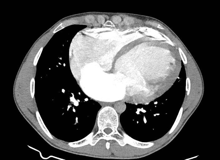 File:Aortic coarctation with aneurysm (Radiopaedia 74818-85828 A 84).jpg