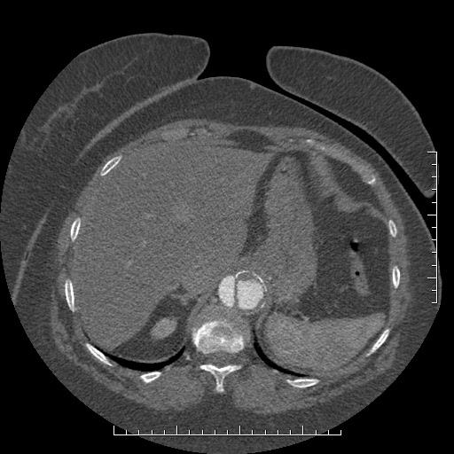 File:Aortic dissection- Stanford A (Radiopaedia 35729-37268 B 26).jpg