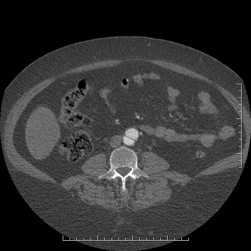File:Aortic dissection- Stanford A (Radiopaedia 35729-37268 C 26).jpg