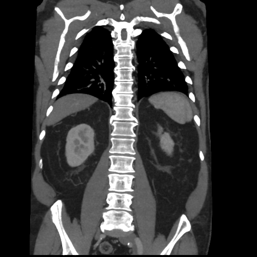 File:Aortic dissection- Stanford A (Radiopaedia 37759-39664 Coronal C+ delayed 39).png