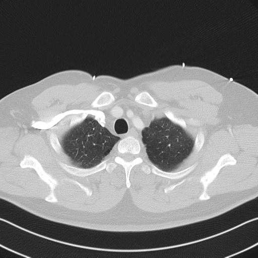 File:Aortic dissection (Radiopaedia 50763-56234 Axial lung window 15).png