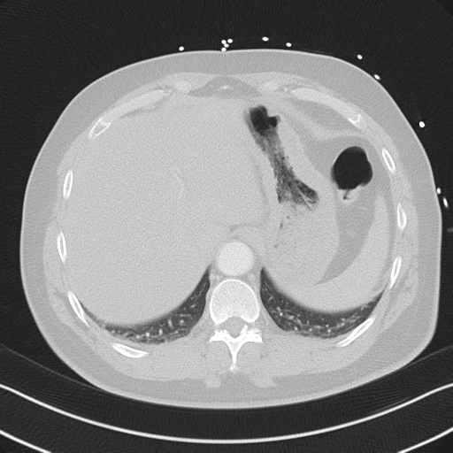 File:Aortic dissection (Radiopaedia 50763-56234 Axial lung window 55).png