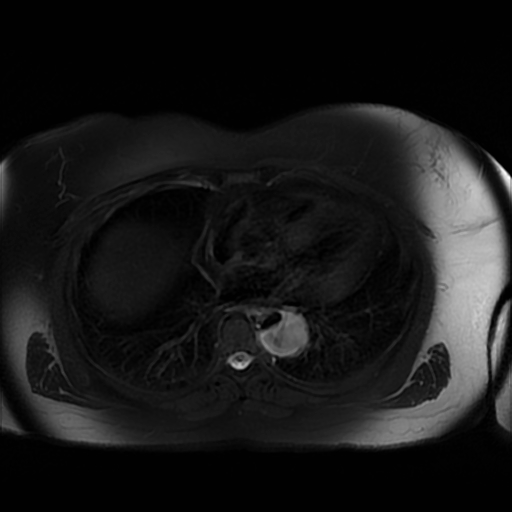 File:Aortic dissection (Radiopaedia 57969-64956 Axial T2 fat sat 6).jpg