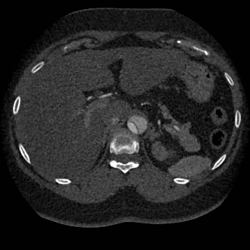 Aortic dissection (Radiopaedia 57969-64959 A 316).jpg