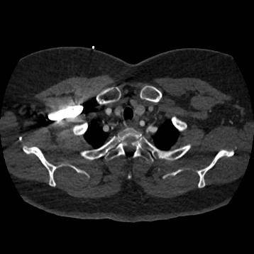 Aortic dissection (Radiopaedia 57969-64959 A 43).jpg