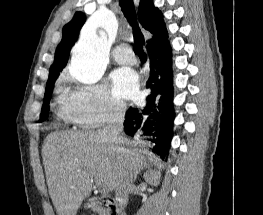 Aortic dissection - Stanford A -DeBakey I (Radiopaedia 28339-28587 C 9).jpg