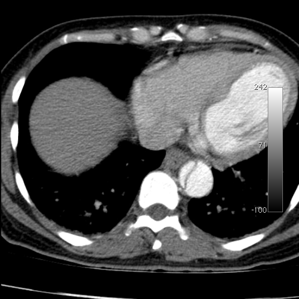 Aortic dissection - Stanford type A (Radiopaedia 29247-29659 A 57).jpg