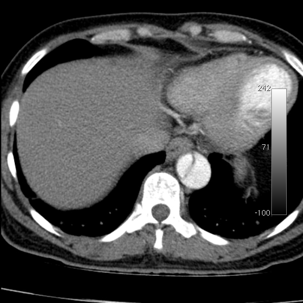 Aortic dissection - Stanford type A (Radiopaedia 29247-29659 A 62).jpg