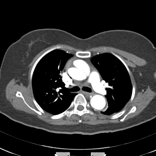 File:Aortic dissection - Stanford type A (Radiopaedia 39073-41259 A 30).png