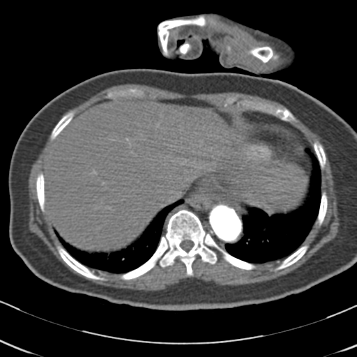 File:Aortic dissection - Stanford type A (Radiopaedia 39073-41259 A 66).png