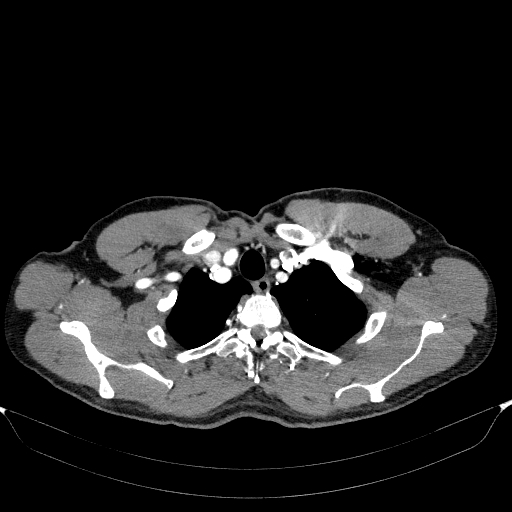 File:Aortic dissection - Stanford type A (Radiopaedia 83418-98500 A 9).jpg