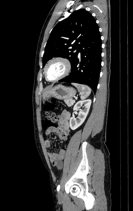 Aortic dissection - Stanford type A (Radiopaedia 83418-98500 B 75).jpg
