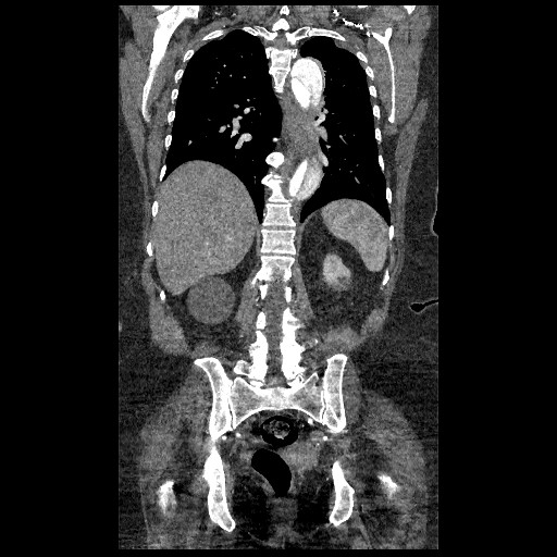 File:Aortic dissection - Stanford type B (Radiopaedia 88281-104910 B 59).jpg