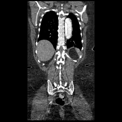 File:Aortic dissection - Stanford type B (Radiopaedia 88281-104910 B 71).jpg