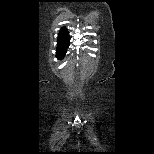 File:Aortic dissection - Stanford type B (Radiopaedia 88281-104910 B 85).jpg