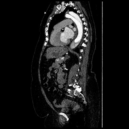 Aortic dissection - Stanford type B (Radiopaedia 88281-104910 C 50).jpg