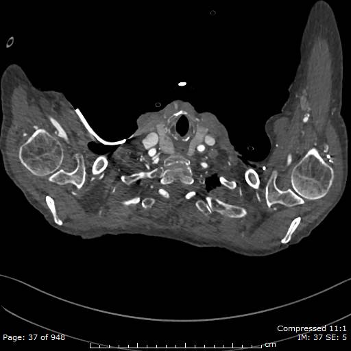 Aortic dissection with extension into aortic arch branches (Radiopaedia 64402-73204 B 37).jpg