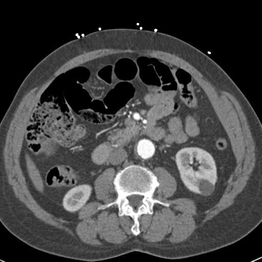 Aortic intramural hematoma (Radiopaedia 31139-31838 B 106).jpg