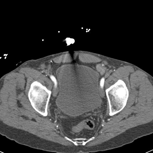 Aortic intramural hematoma (Radiopaedia 31139-31838 B 156).jpg