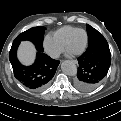 Aortic intramural hematoma (Radiopaedia 34260-35540 Axial non-contrast 45).png