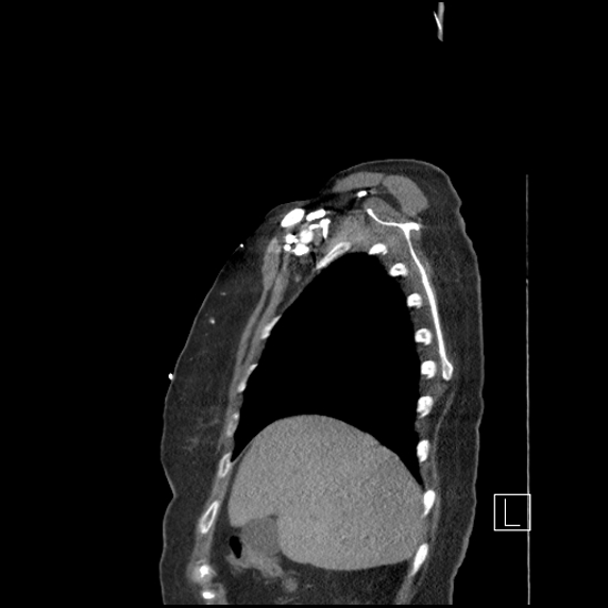 Aortic intramural hematoma with dissection and intramural blood pool (Radiopaedia 77373-89491 D 12).jpg