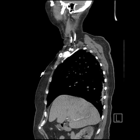 Aortic intramural hematoma with dissection and intramural blood pool (Radiopaedia 77373-89491 D 25).jpg