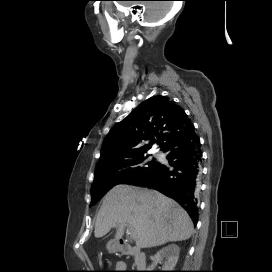 Aortic intramural hematoma with dissection and intramural blood pool (Radiopaedia 77373-89491 D 27).jpg