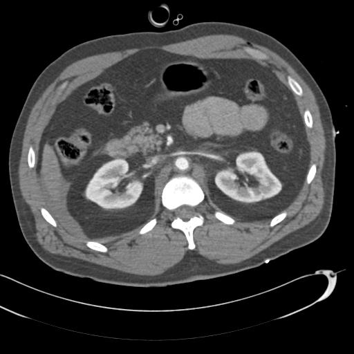 Aortic transection, diaphragmatic rupture and hemoperitoneum in a complex multitrauma patient (Radiopaedia 31701-32622 A 102).jpg