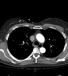 Aortic valve endocarditis (Radiopaedia 87209-103485 C 30).jpg