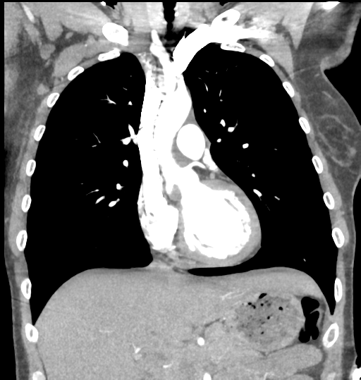 File:Aortic valve non-coronary cusp thrombus (Radiopaedia 55661-62189 C 33).png