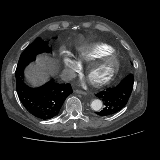 File:Aorto-coronary bypass graft aneurysms (Radiopaedia 40562-43157 A 91).png