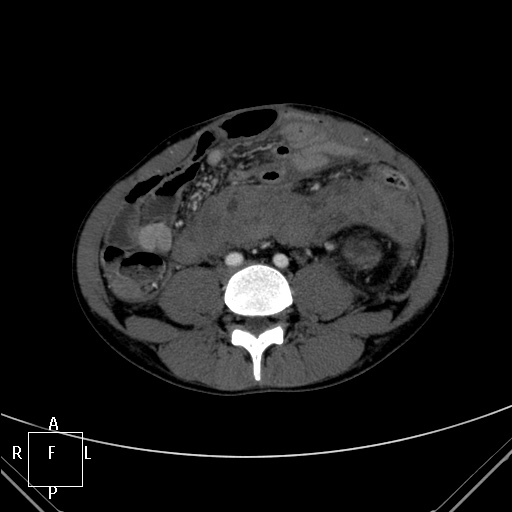 File:Aorto-left renal vein fistula (Radiopaedia 45534-49628 A 45).jpg