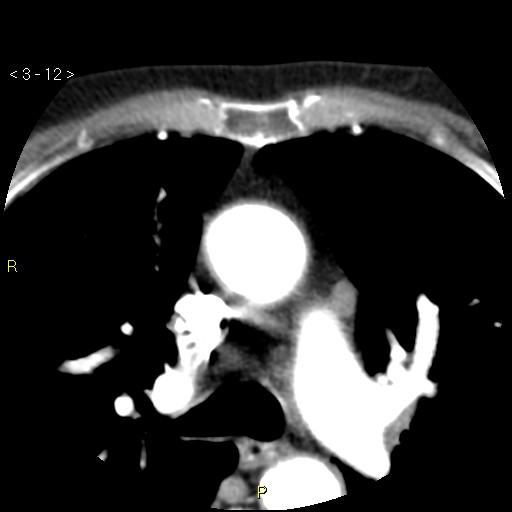 Aortoiliac occlusive disease (Radiopaedia 16828-16548 A 12).jpg