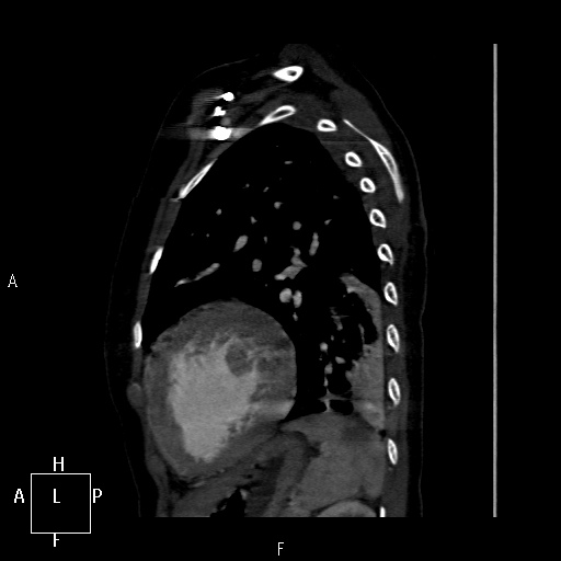 File:Aortopulmonary septal defect (Radiopaedia 41990-45013 Sagittal C+ CTPA 2).jpg
