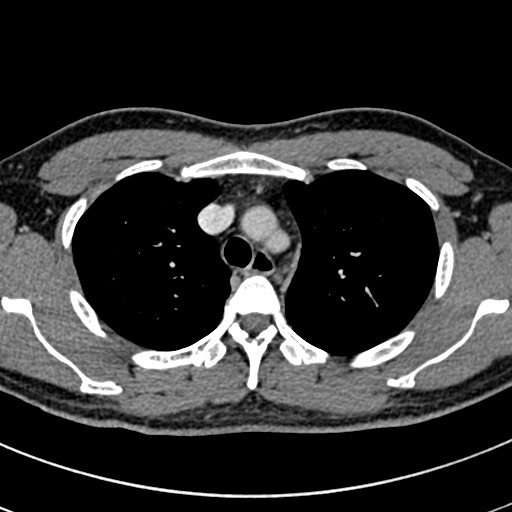 Apical lung mass mimic - neurogenic tumor (Radiopaedia 59918-67521 A 22).jpg