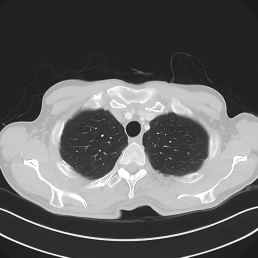 Apical pleural calcification (Radiopaedia 46141-50499 Axial lung window 14).png