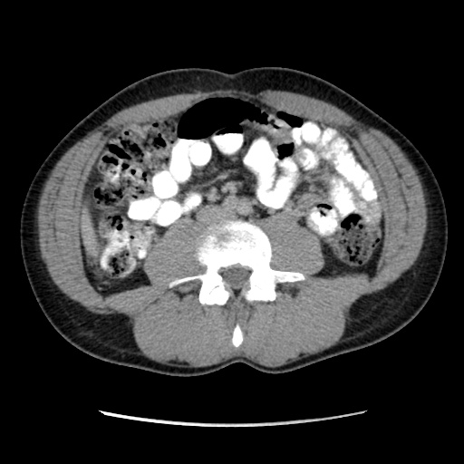 File:Appendicitis complicated by post-operative collection (Radiopaedia 35595-37113 A 40).jpg