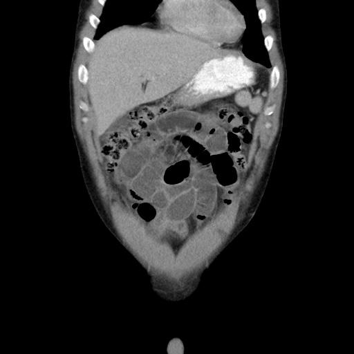 Appendicitis complicated by post-operative collection (Radiopaedia 35595-37114 B 14).jpg