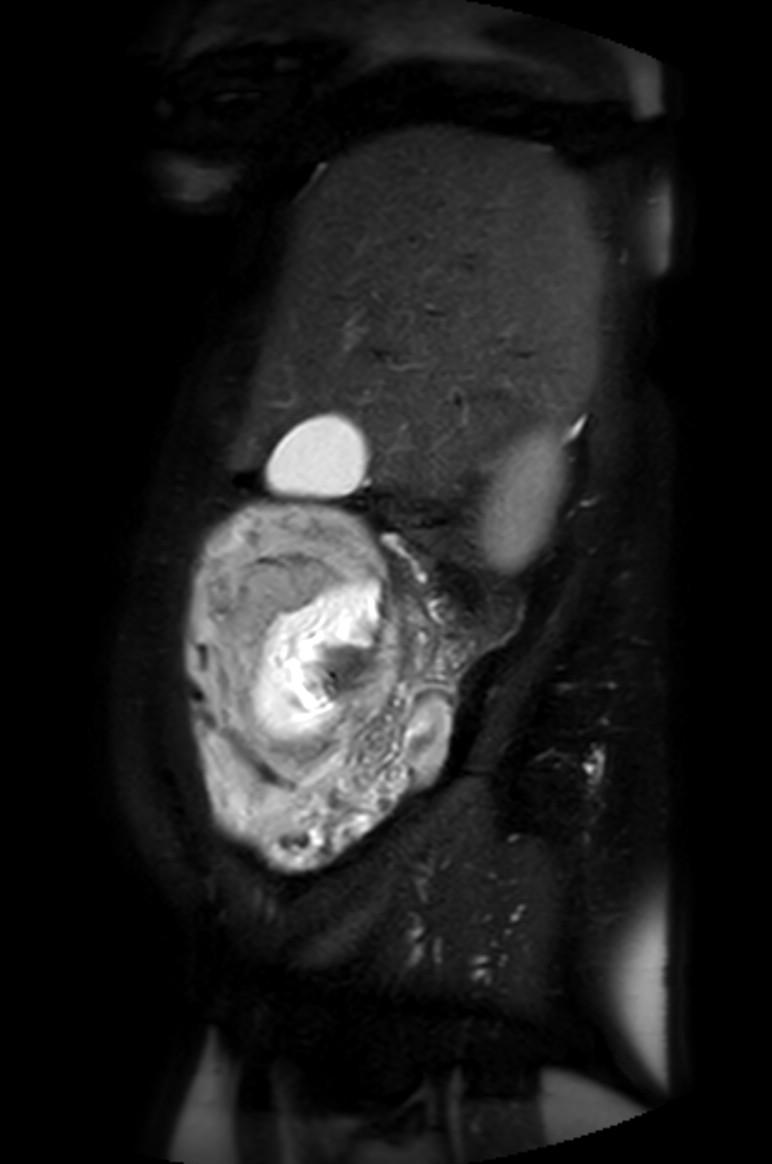 Appendicitis in gravida (MRI) (Radiopaedia 89433-106395 Sagittal T2 SPAIR 50).jpg