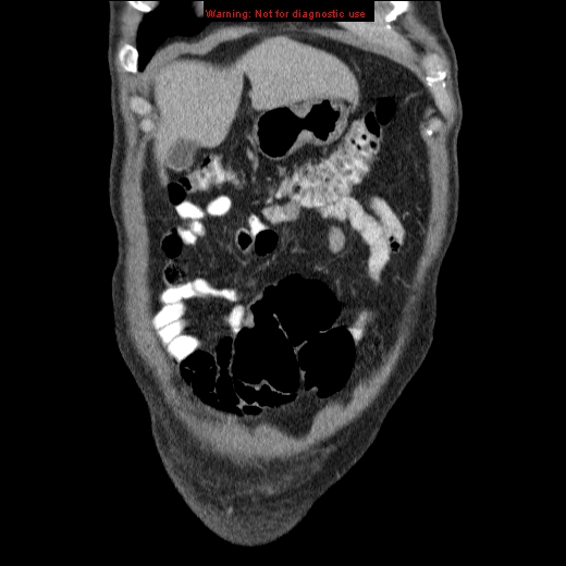 File:Appendicitis mass in inguinal hernia (Radiopaedia 26858-27029 B 8).jpg