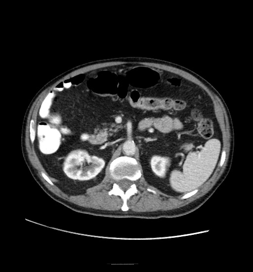 File:Appendicitis with localized perforation and abscess formation (Radiopaedia 49035-54130 A 35).jpg