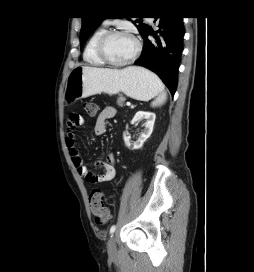 Appendicitis with localized perforation and abscess formation (Radiopaedia 49035-54130 C 45).jpg