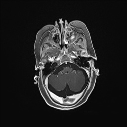 Aqueductal stenosis (Radiopaedia 73974-84802 Axial T1 C+ 49).jpg