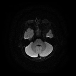 Arachnoid cyst - middle cranial fossa (Radiopaedia 86780-102938 Axial DWI 22).jpg