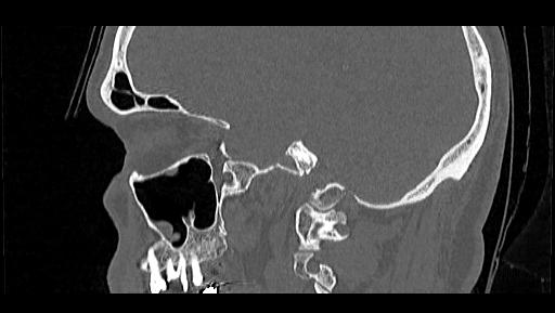 File:Arcuate foramen (Radiopaedia 89833-106944 Sagittal bone window 18).jpg