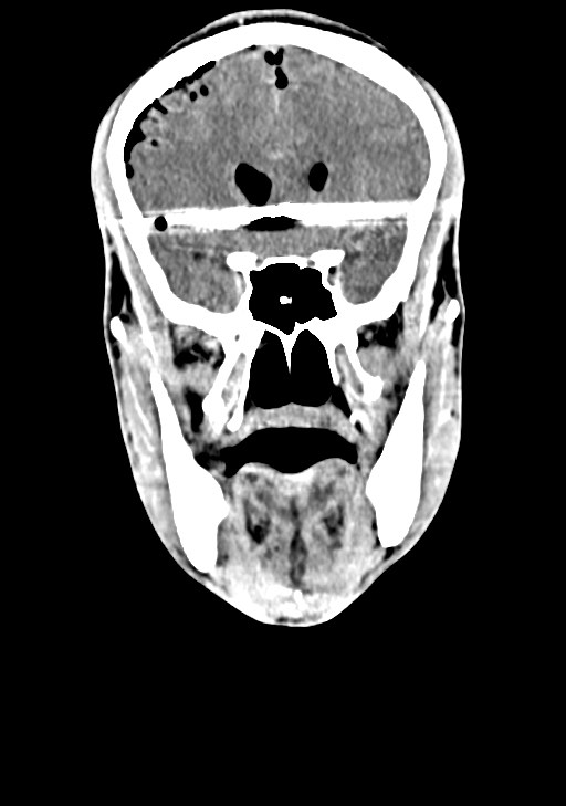 Arrow injury to the brain (Radiopaedia 72101-82607 Coronal non-contrast 31).jpg